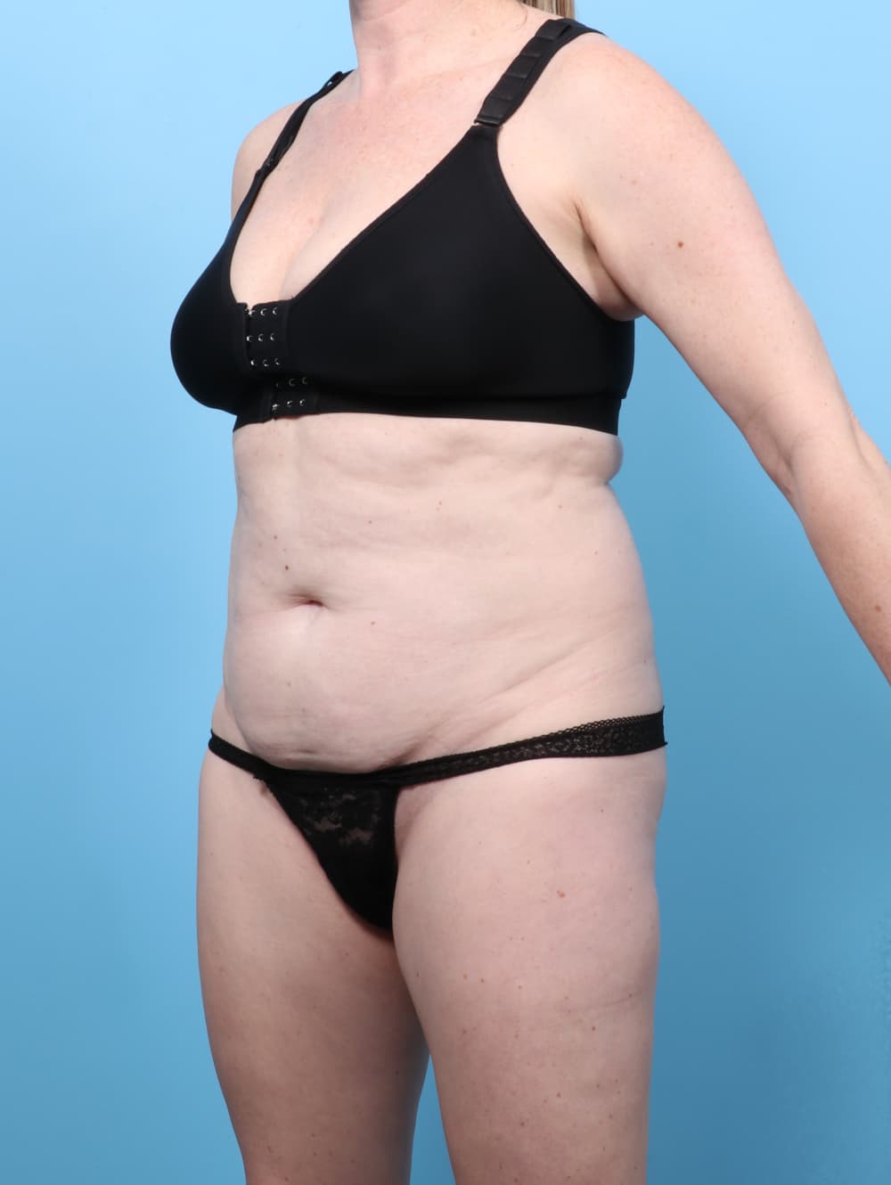 Tummy Tuck case #8674 before, image 2