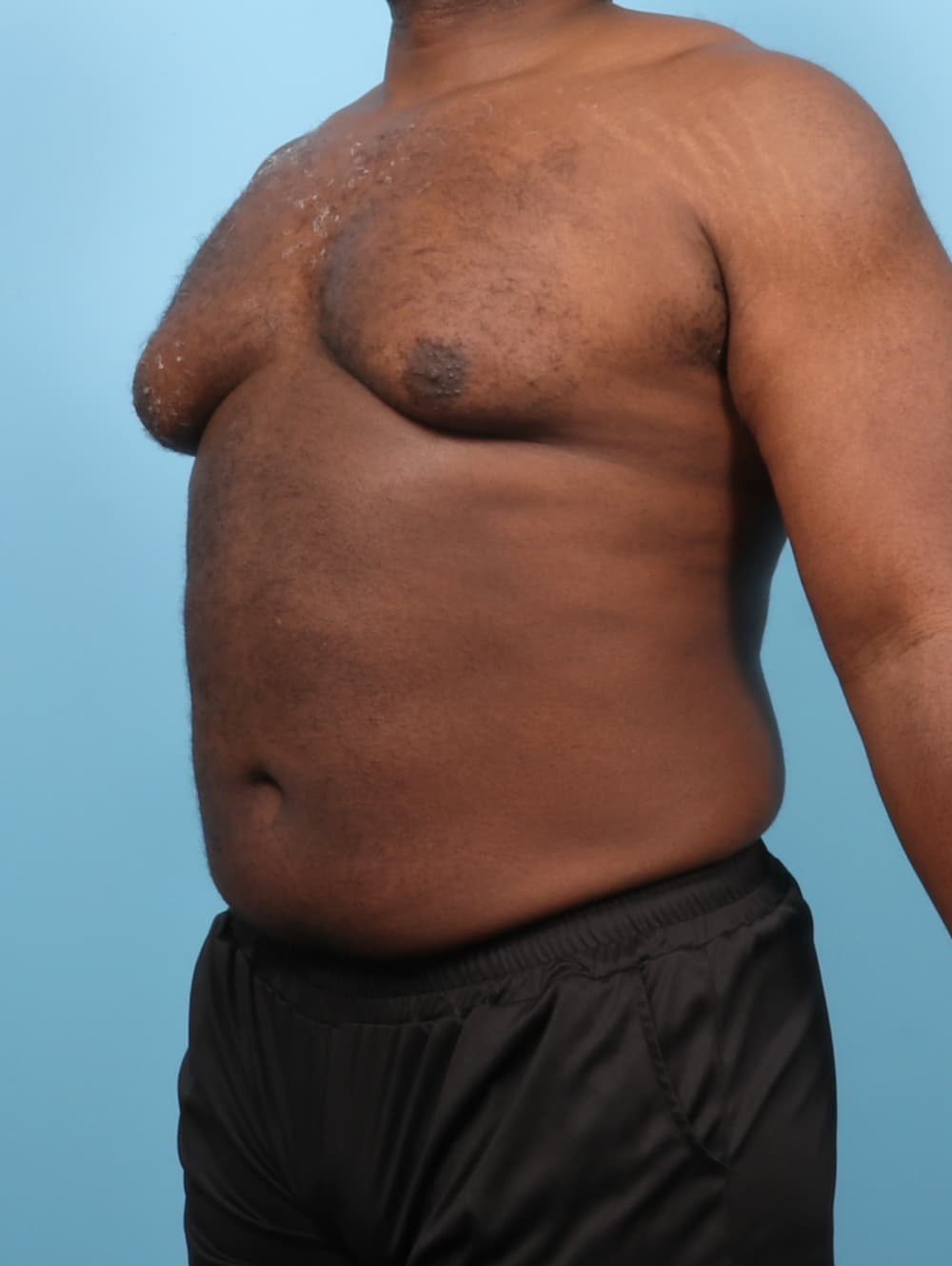 Male Breast Reduction case #7543 before, image 2