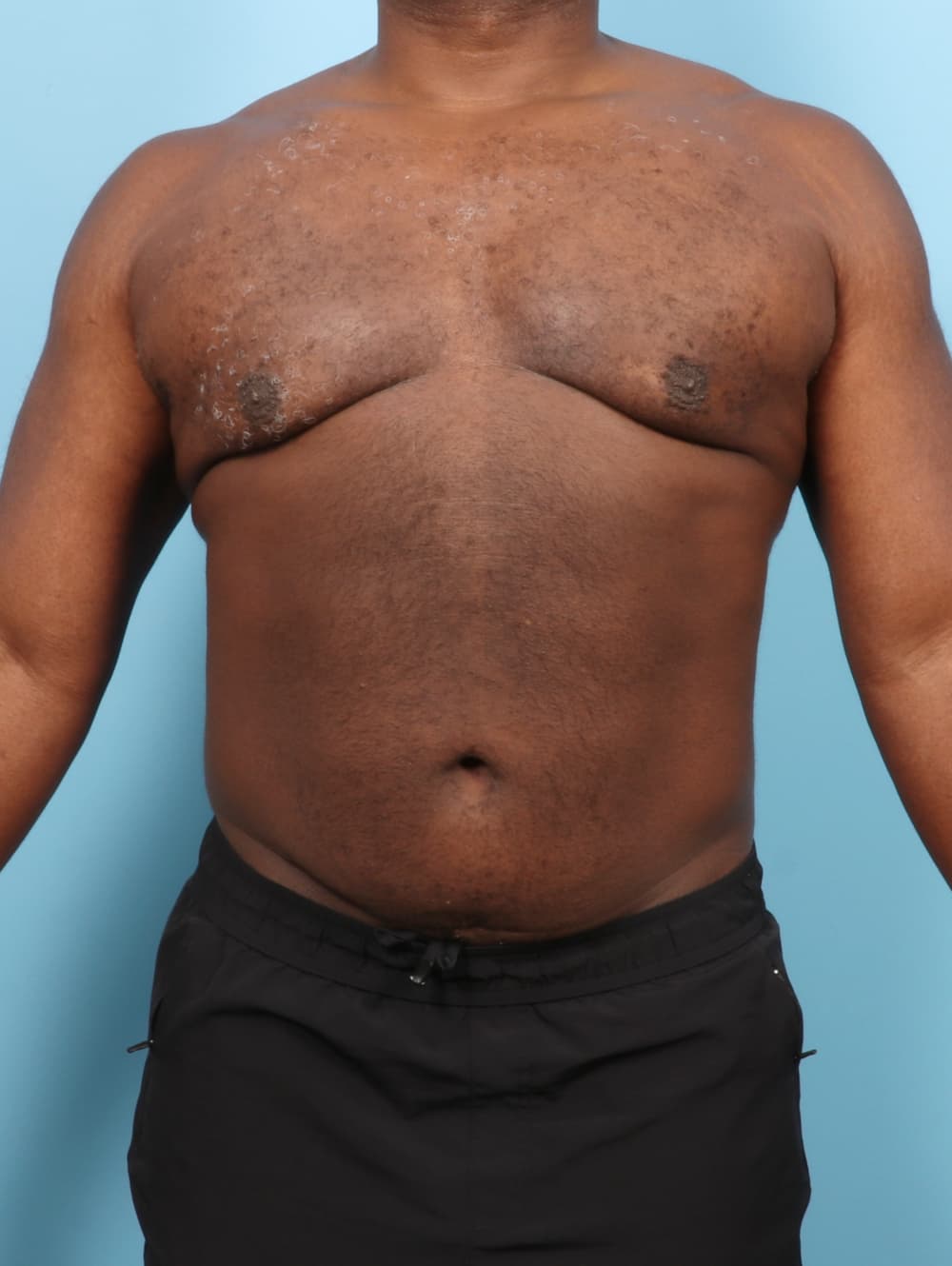 Body Contouring case #7543 after