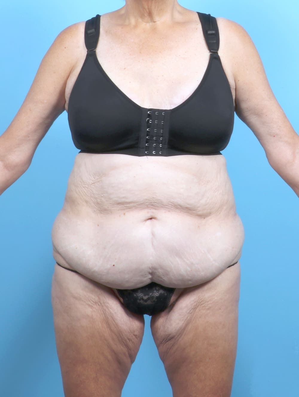 Tummy Tuck case #6885 before