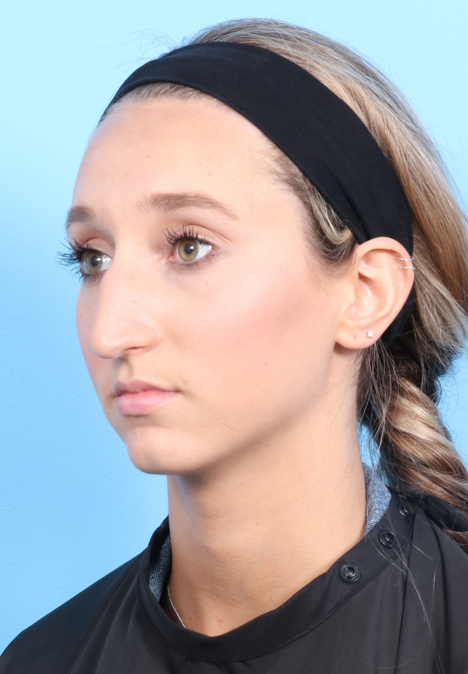 Rhinoplasty case #1321 before, image 3