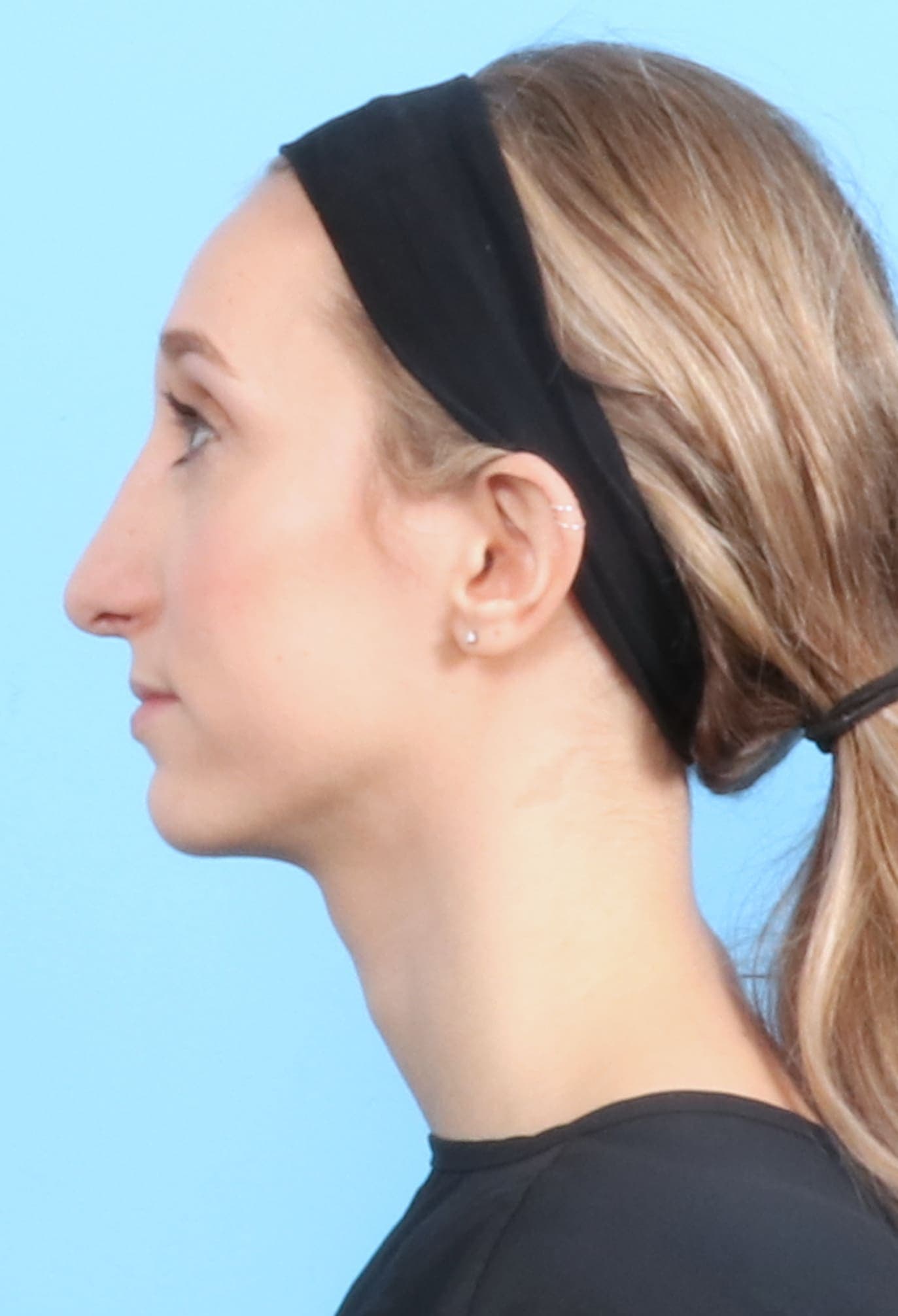 Rhinoplasty case #1321 after