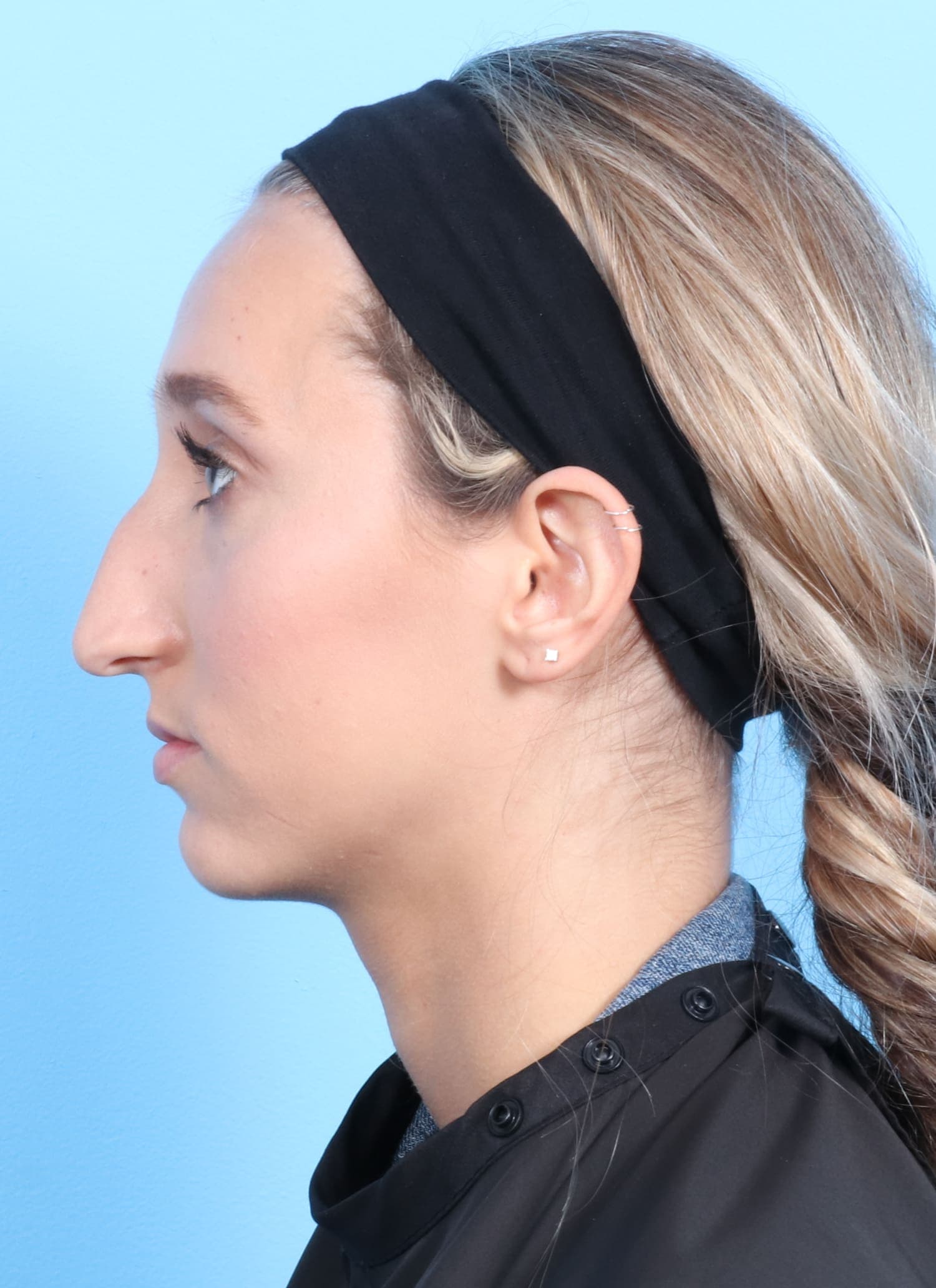 Rhinoplasty case #1321 before