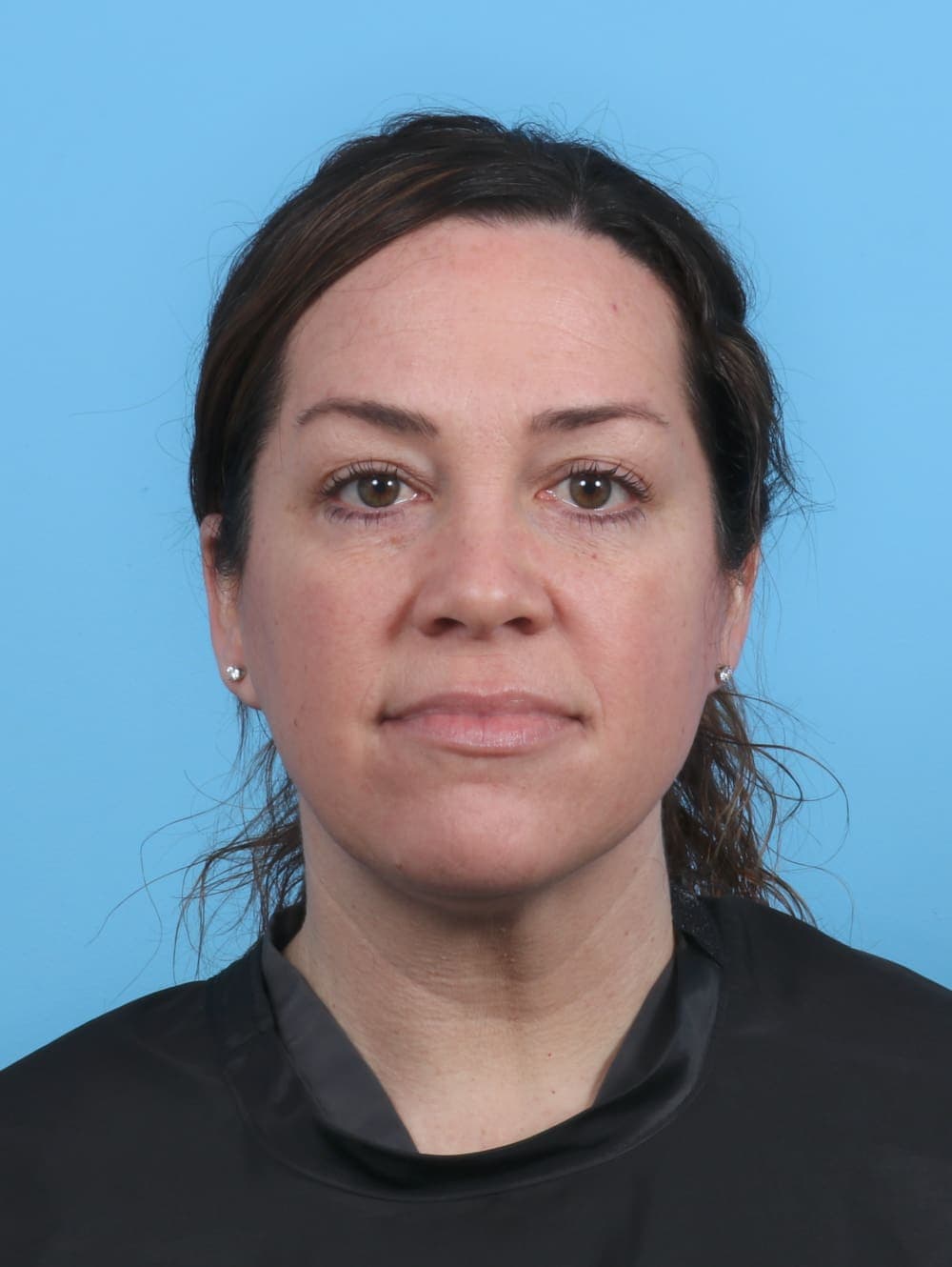 Eyelid Surgery case #4387 after