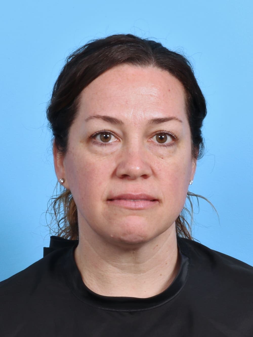 Eyelid Surgery case #4387 before