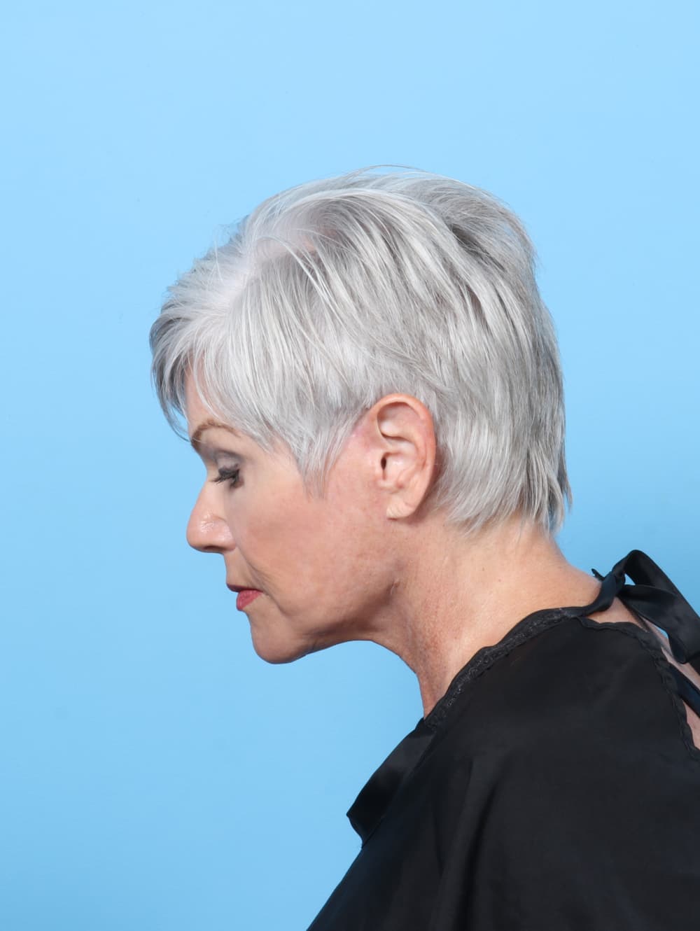 Facelift case #8306 after, image 2