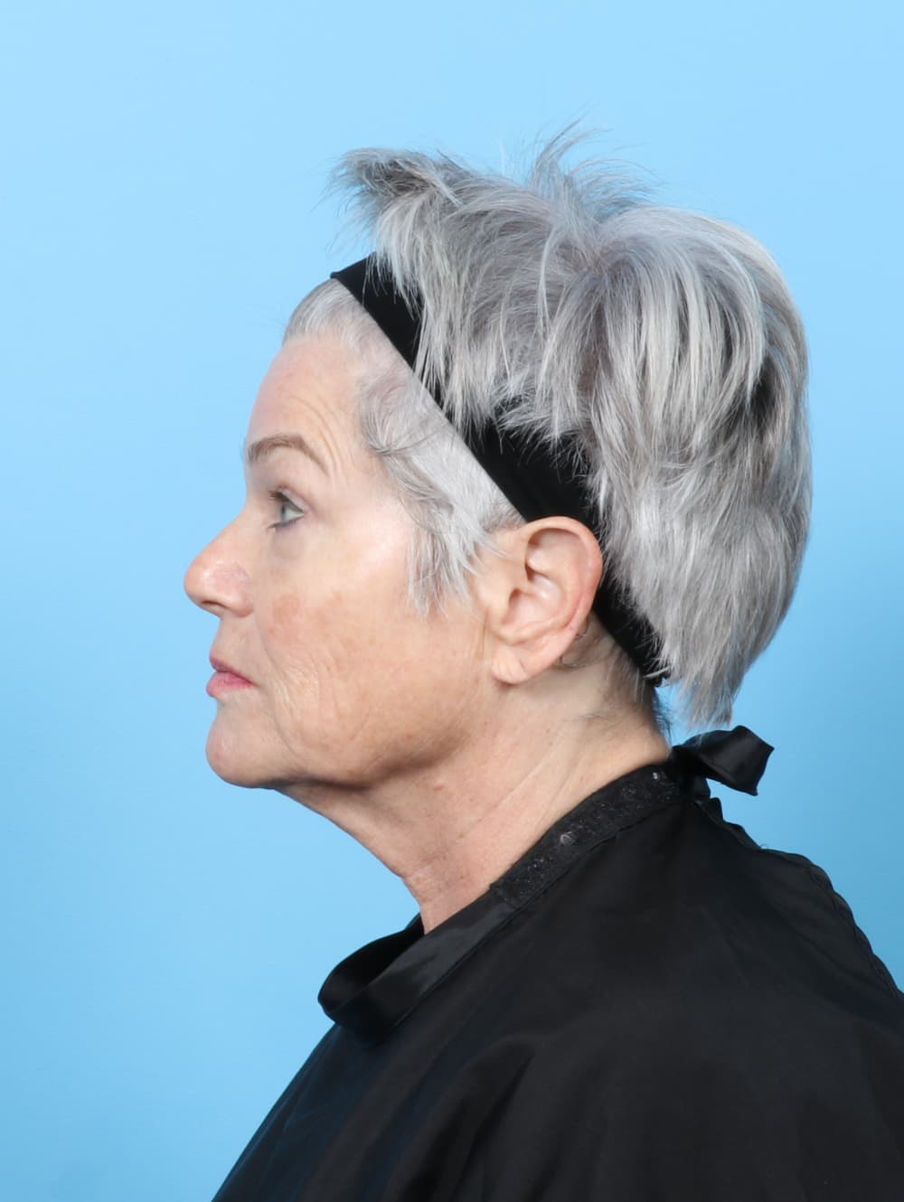 Facelift case #8306 before, image 3
