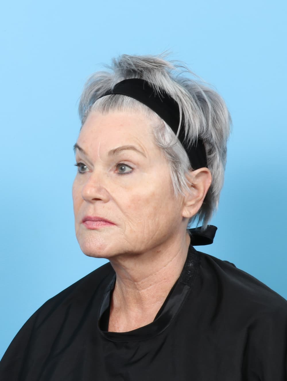Facelift case #8306 before, image 4