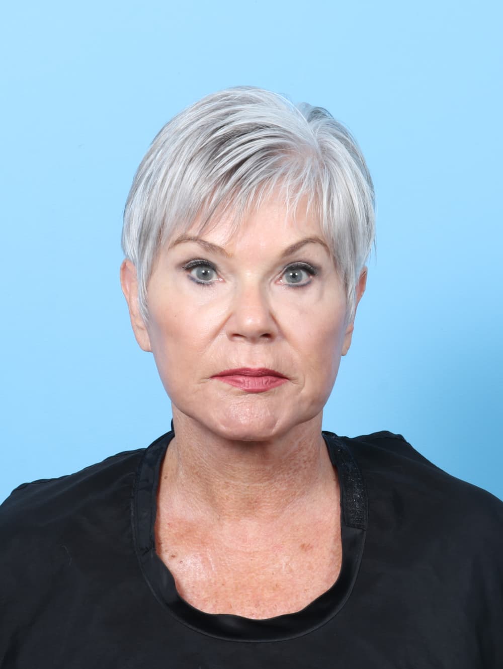 Facelift case #8306 after, image 1