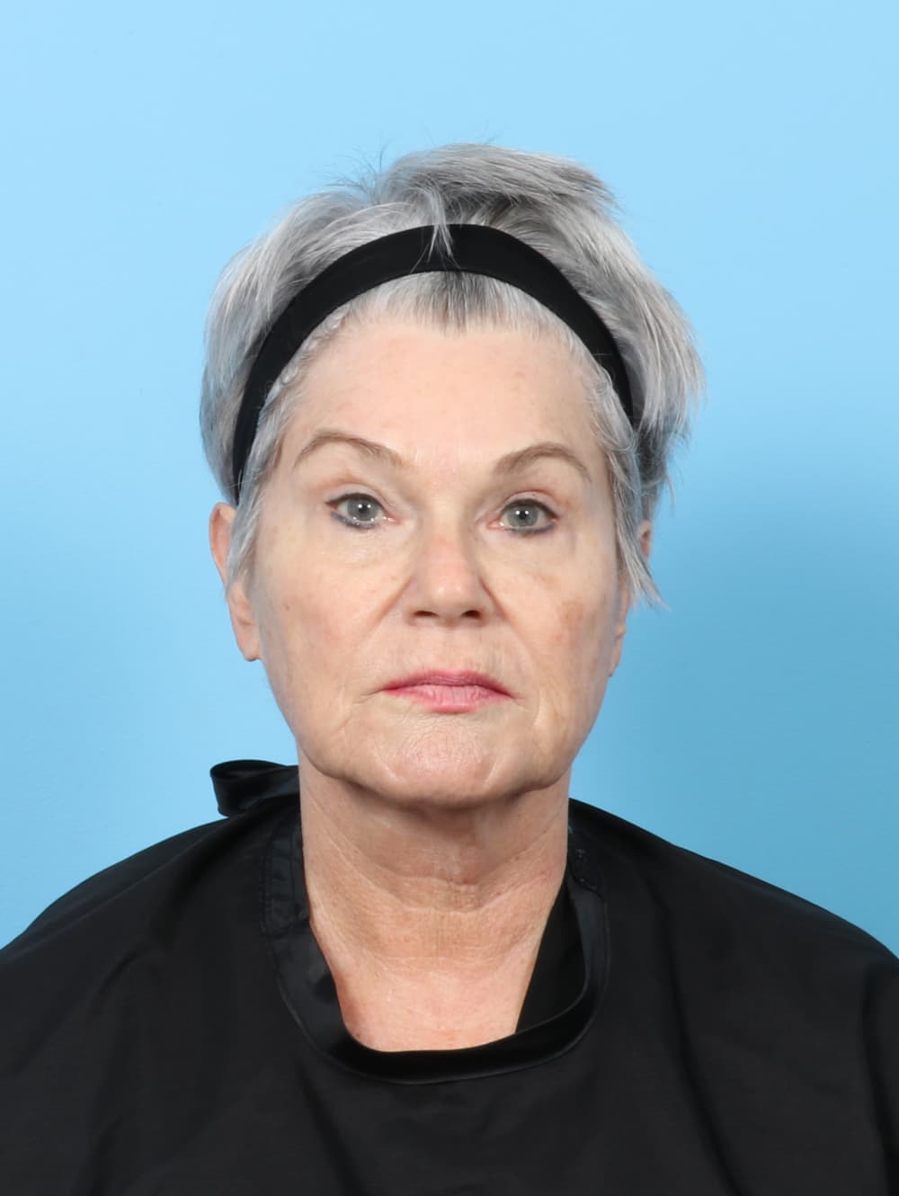 Facelift case #8306 before, image 1