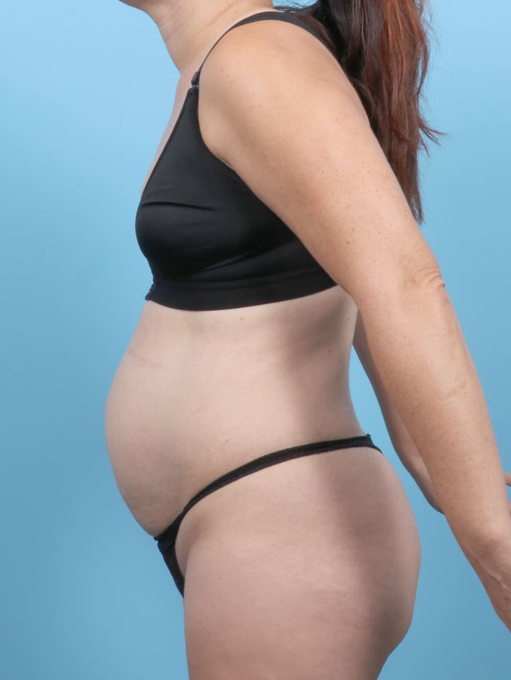 Tummy Tuck case #6777 before, image 3
