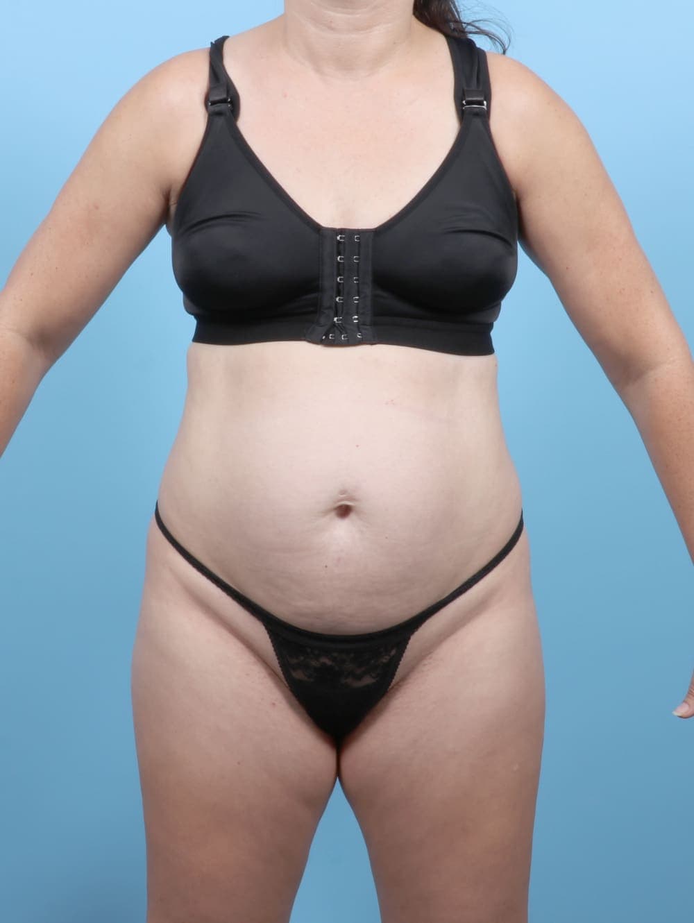 Tummy Tuck case #6777 before