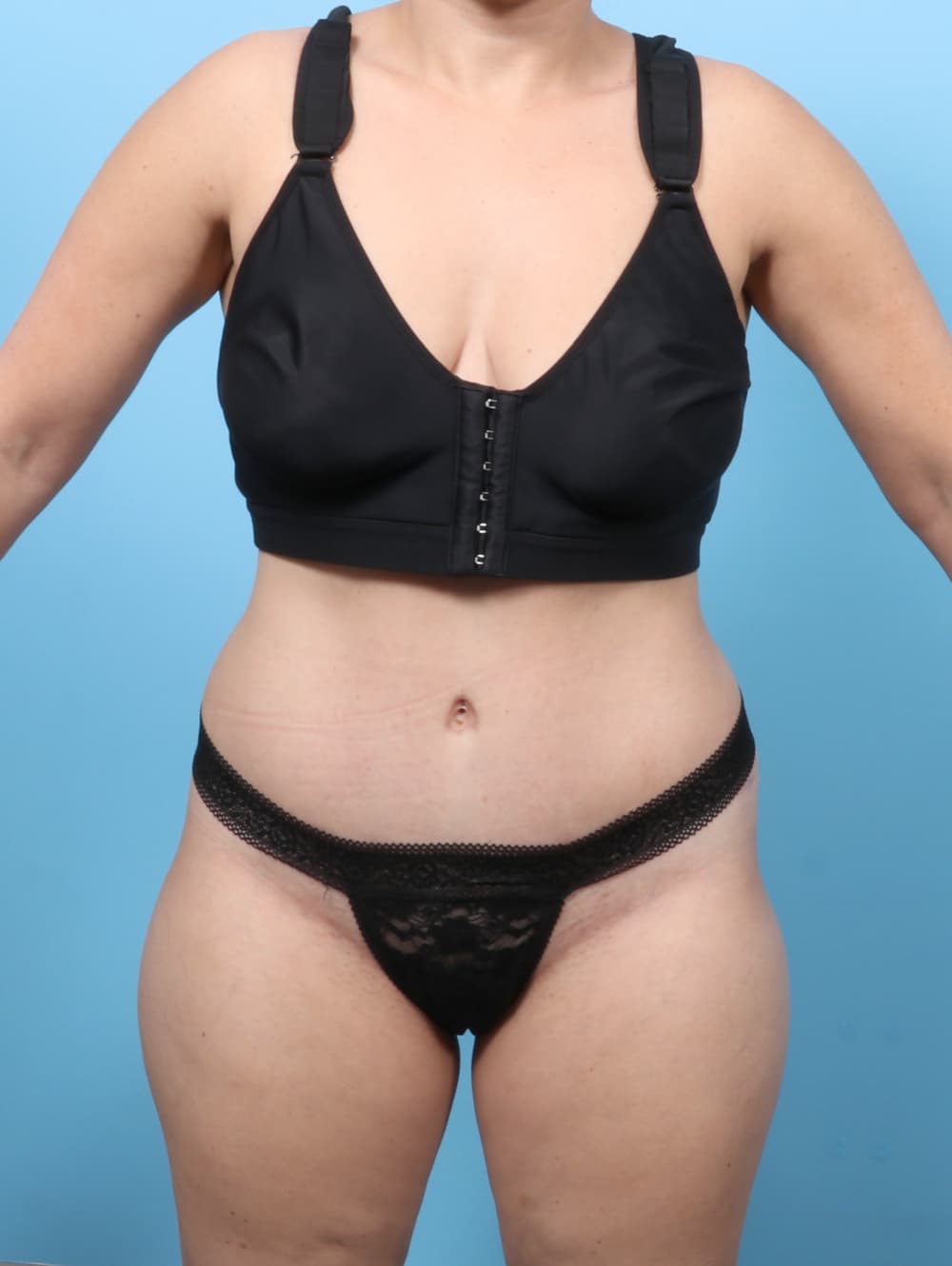 Body Contouring case #8255 after