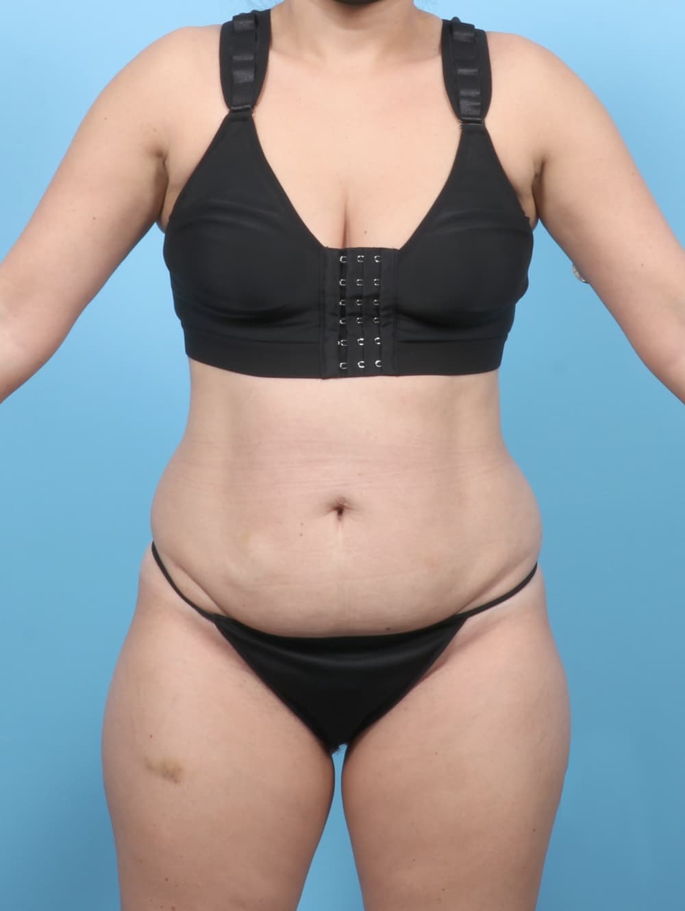 Body Contouring case #8255 before