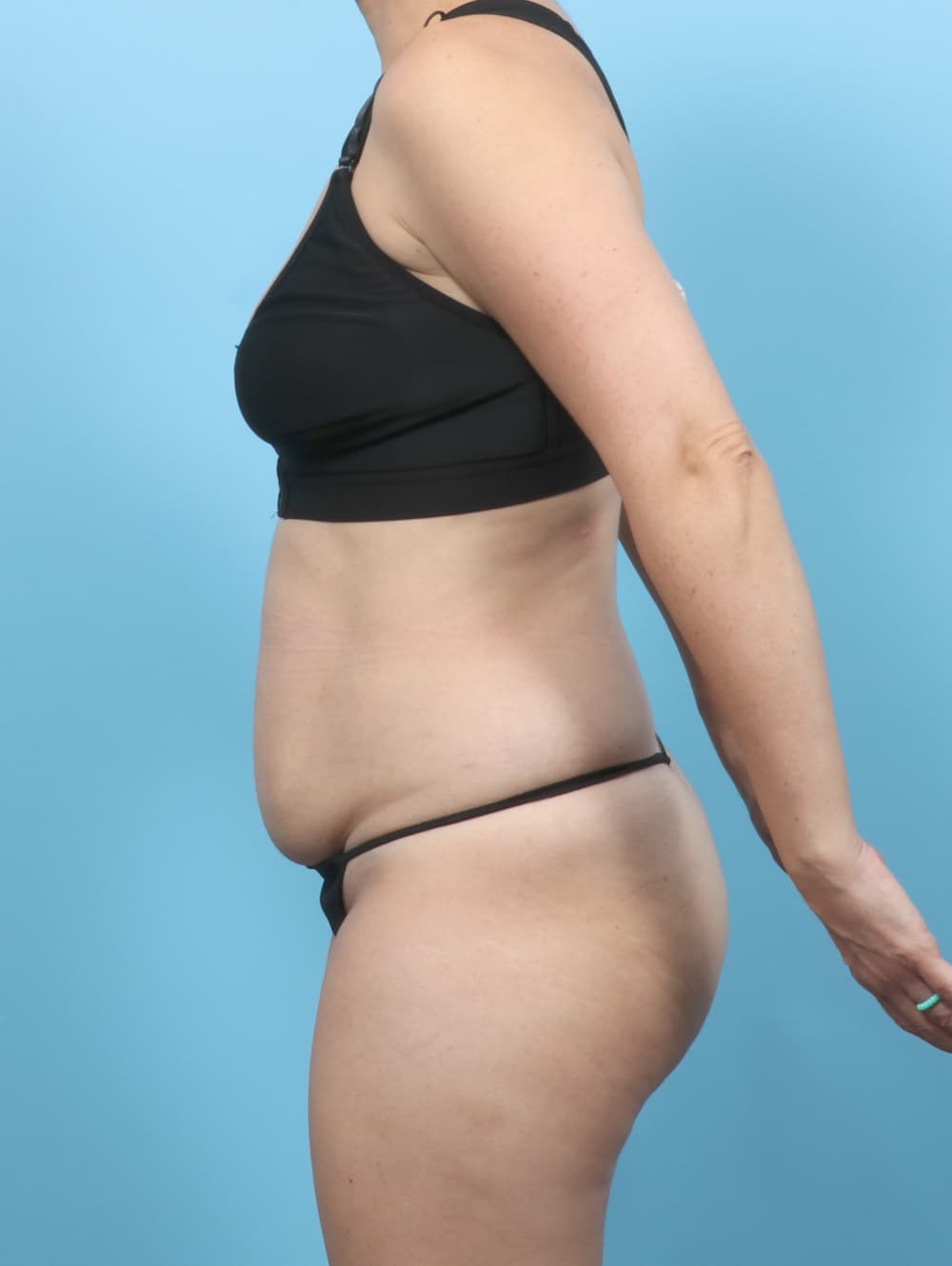 Tummy Tuck case #8255 before, image 3