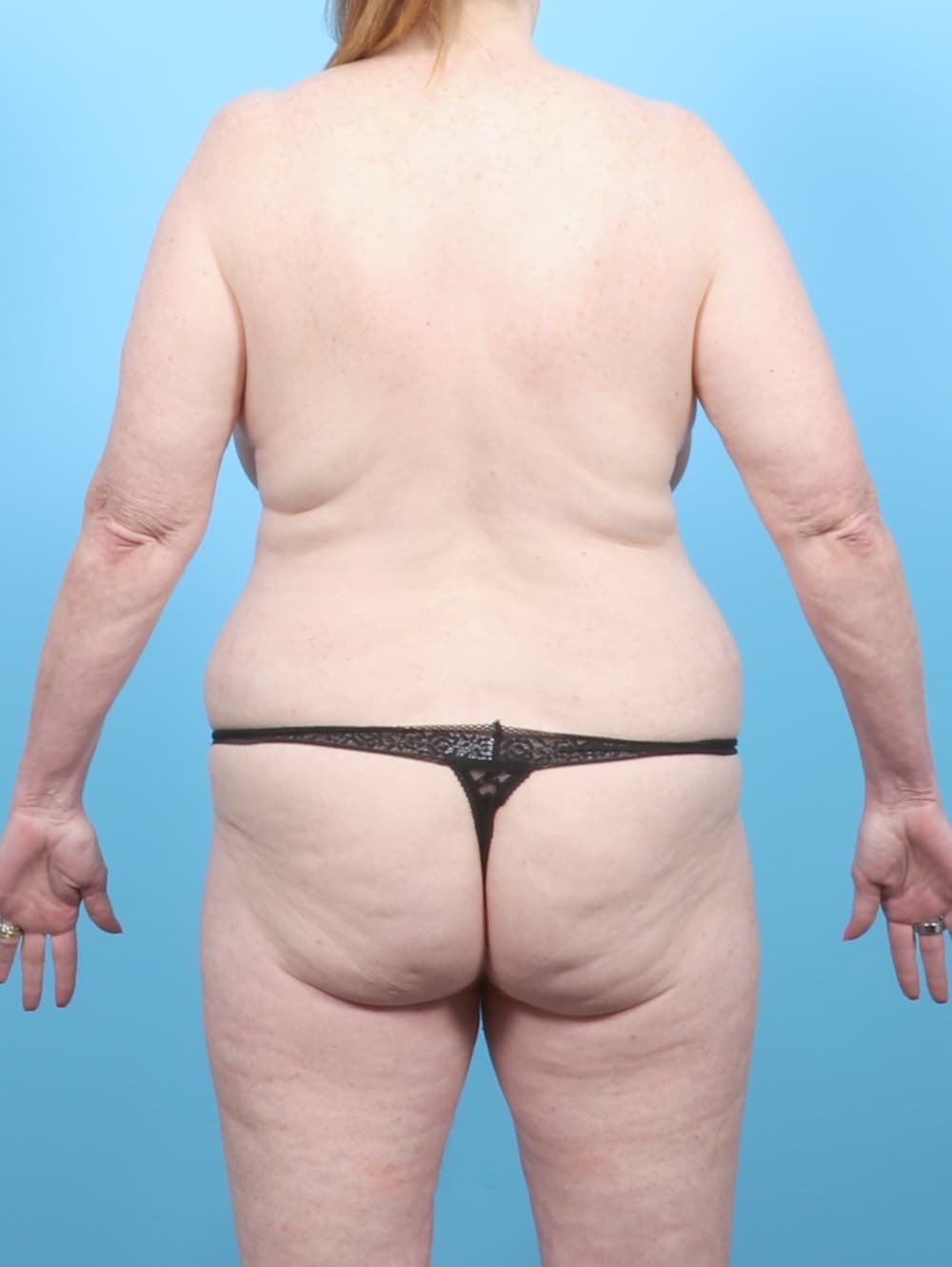 Tummy Tuck case #7716 before, image 4