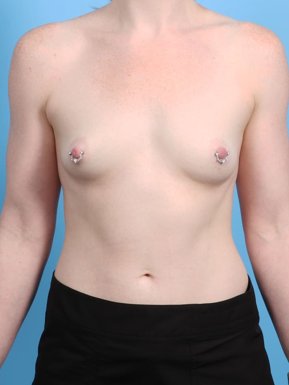 Breast Augmentation case #2897 before, image 1