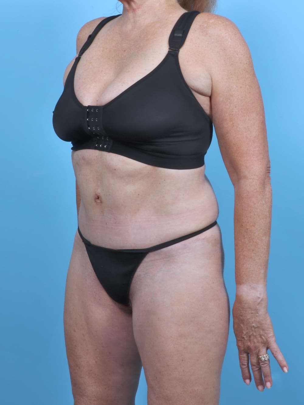 Tummy Tuck case #5474 after, image 2