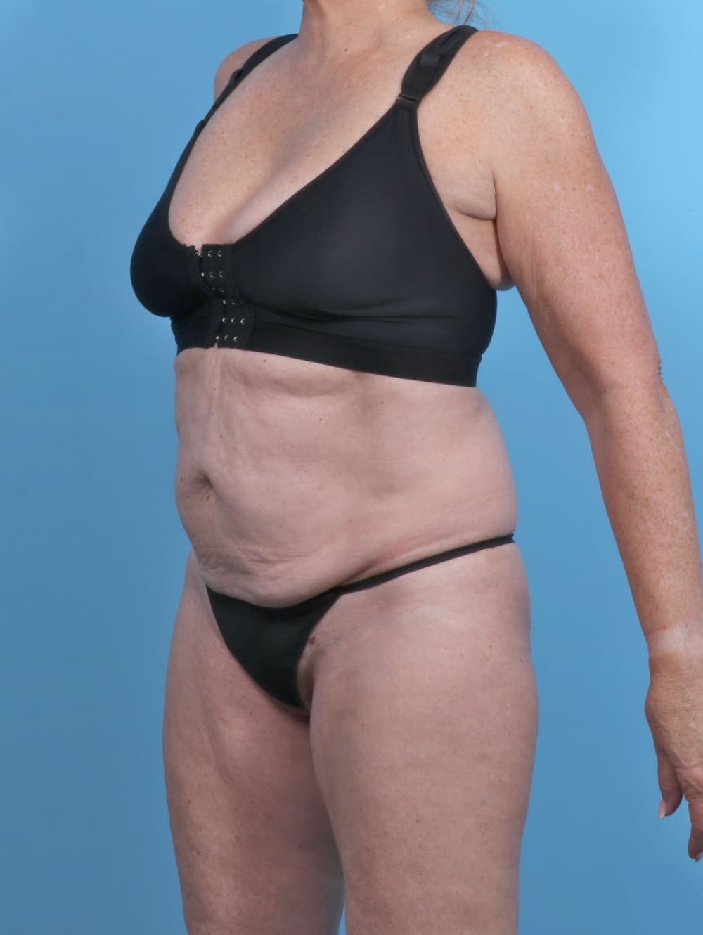 Tummy Tuck case #5474 before, image 2