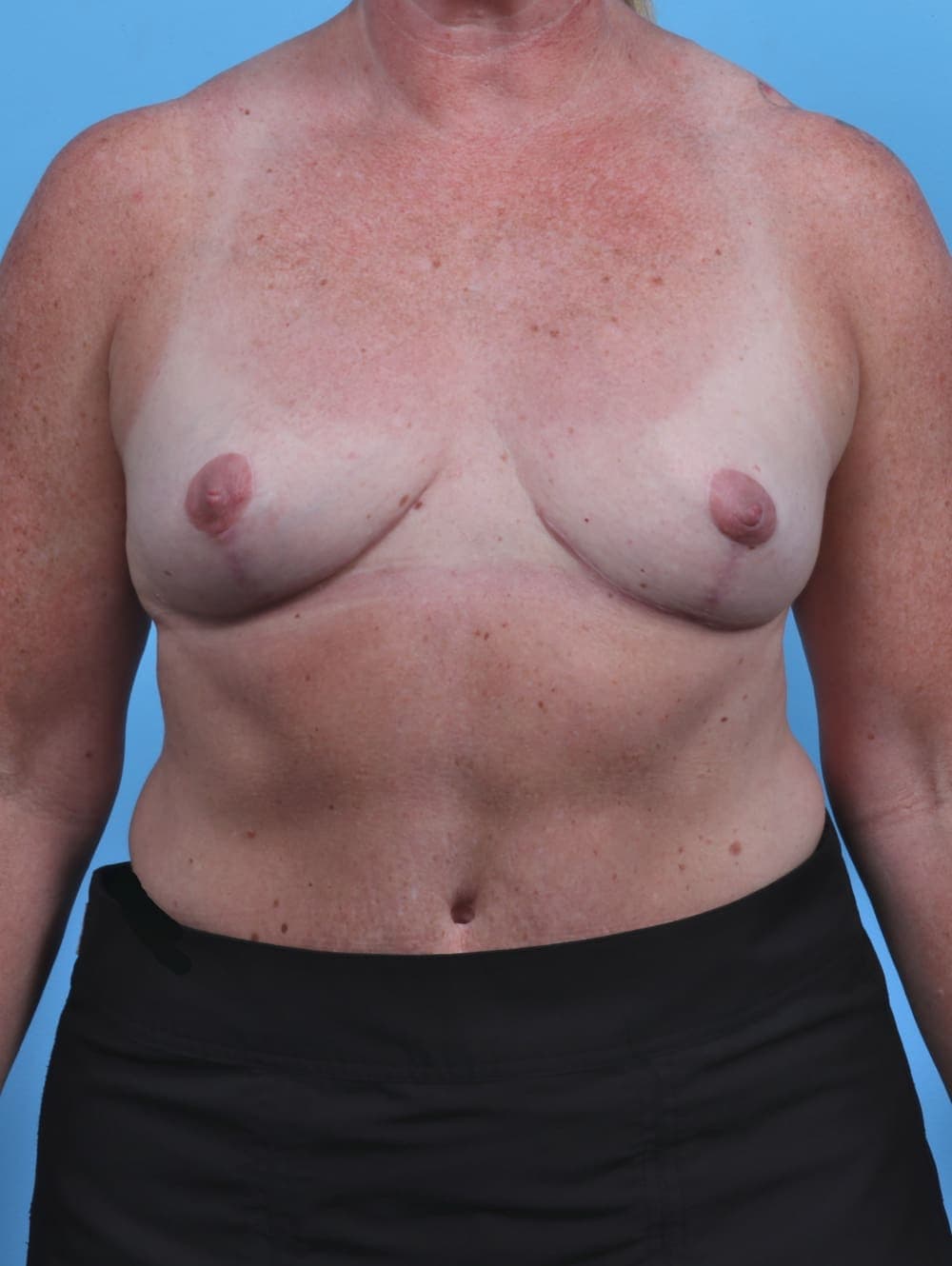 Breast Implant Removal with Lift case #3717 after, image 1