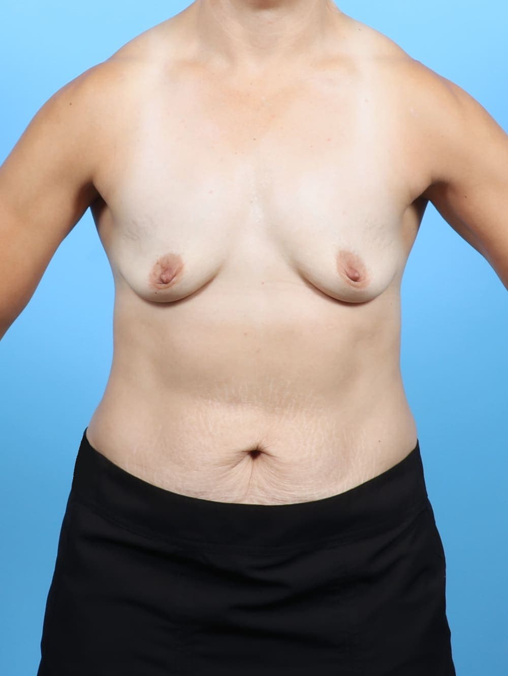 Breast Augmentation case #6743 before