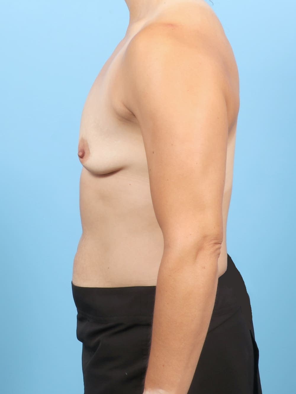 Breast Augmentation case #6743 before, image 3