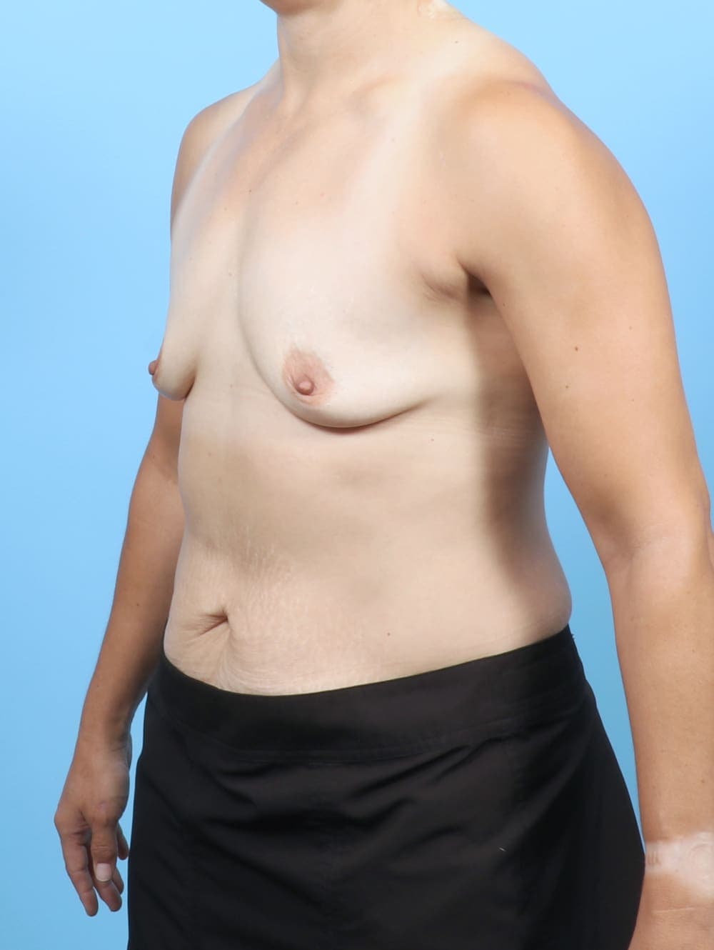 Breast Augmentation case #6743 before, image 2