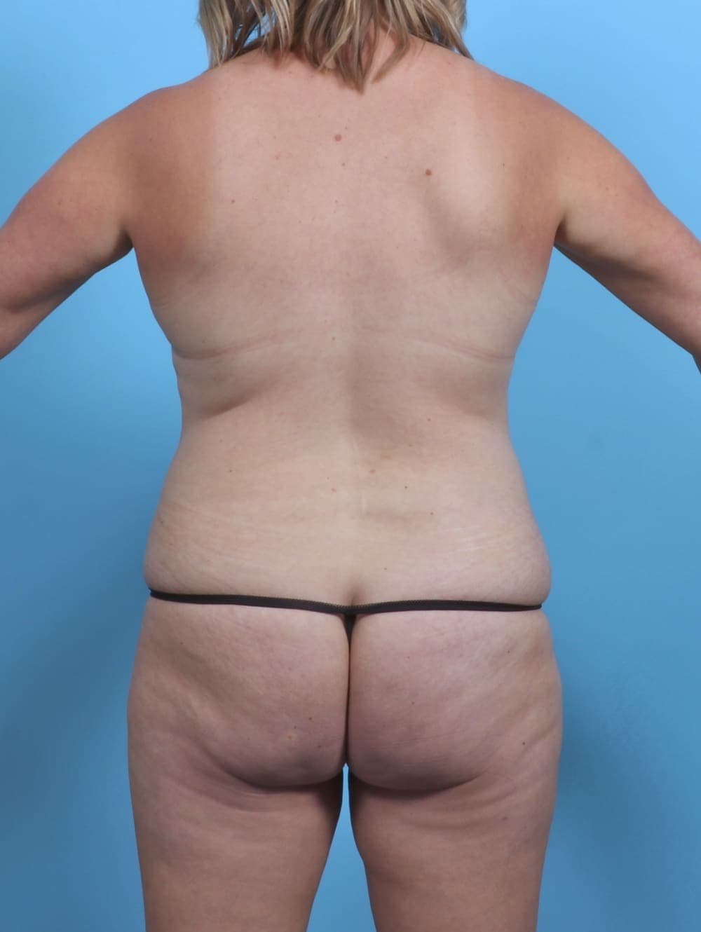 Mommy Makeover case #5058 before, image 4