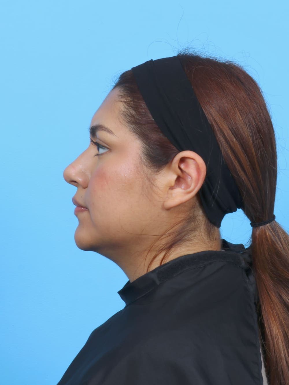 Facial Surgery case #6066 after