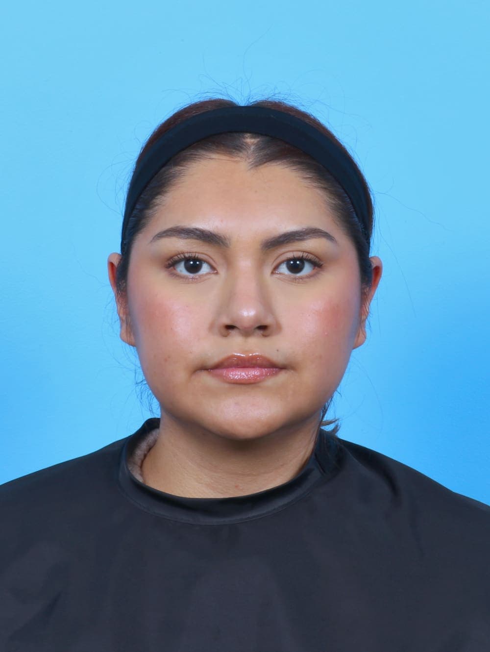 Rhinoplasty case #6066 after, image 2