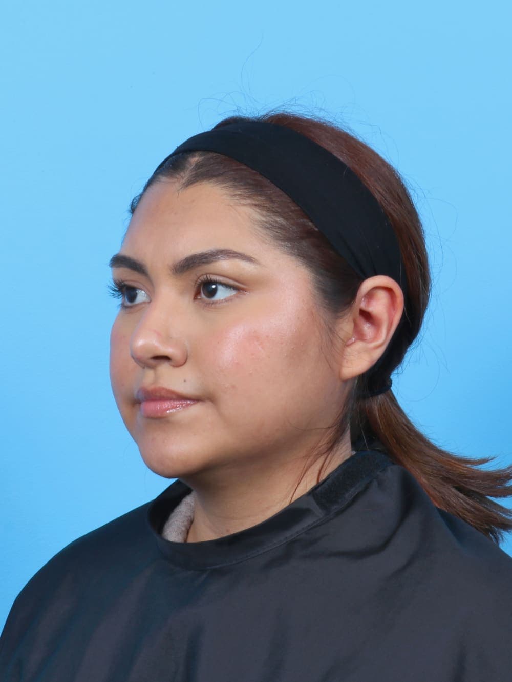 Rhinoplasty case #6066 after, image 3