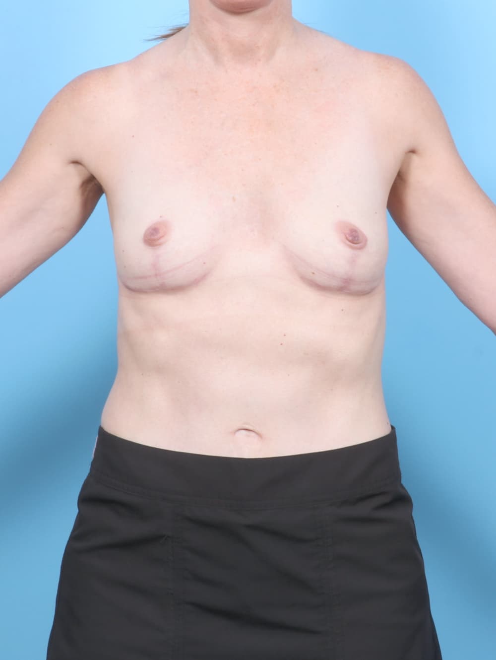 Breast Implant Removal with Lift case #7096 after, image 1