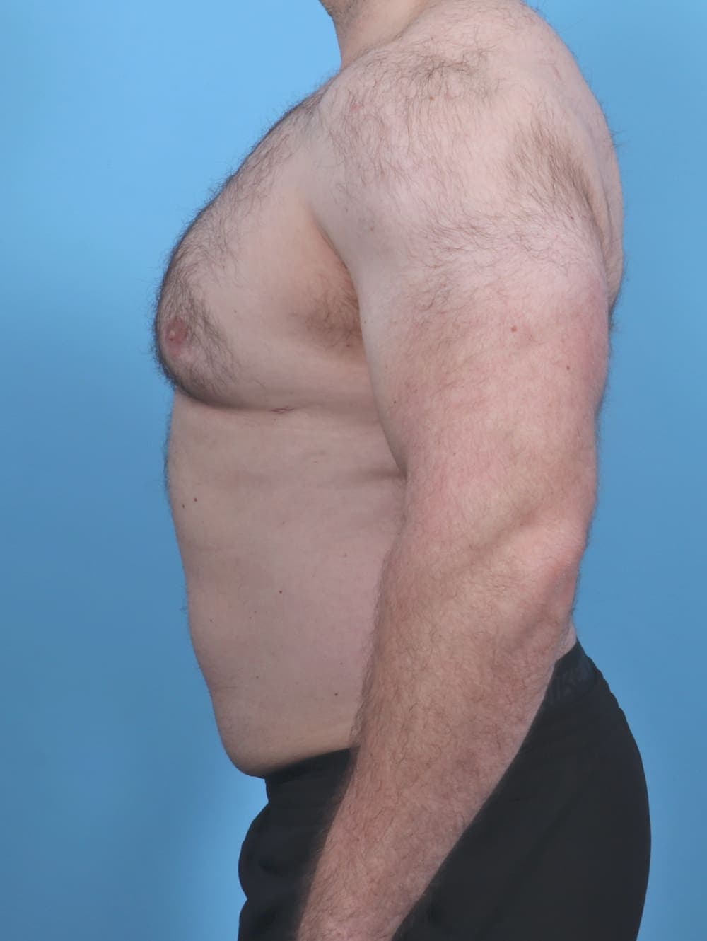 Male Breast Reduction case #5042 after, image 3