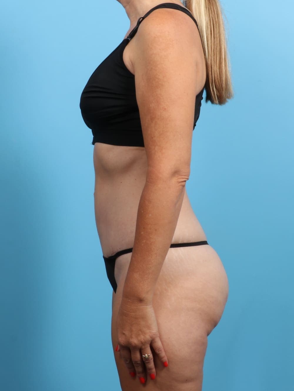 Tummy Tuck case #2703 after, image 3