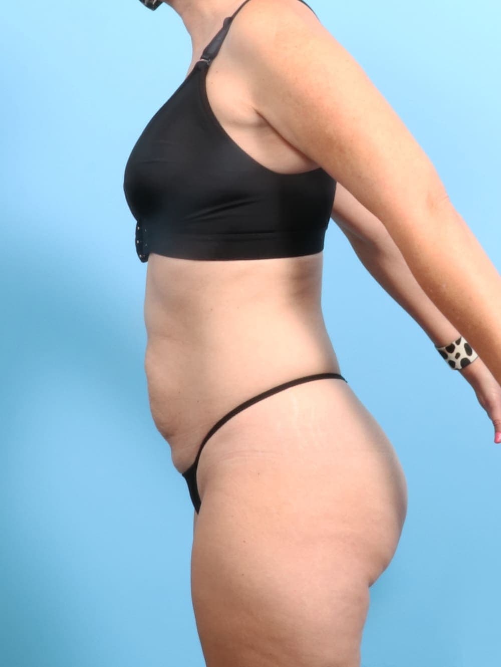 Tummy Tuck case #2703 before, image 3