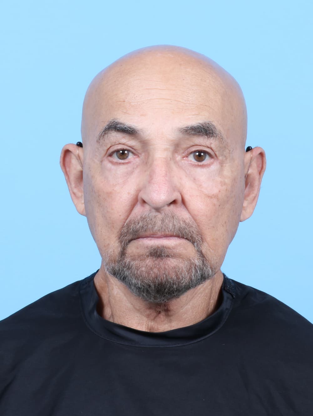 Facial Surgery case #7062 after