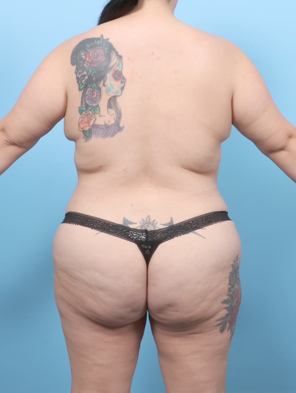 Tummy Tuck case #7905 after, image 4