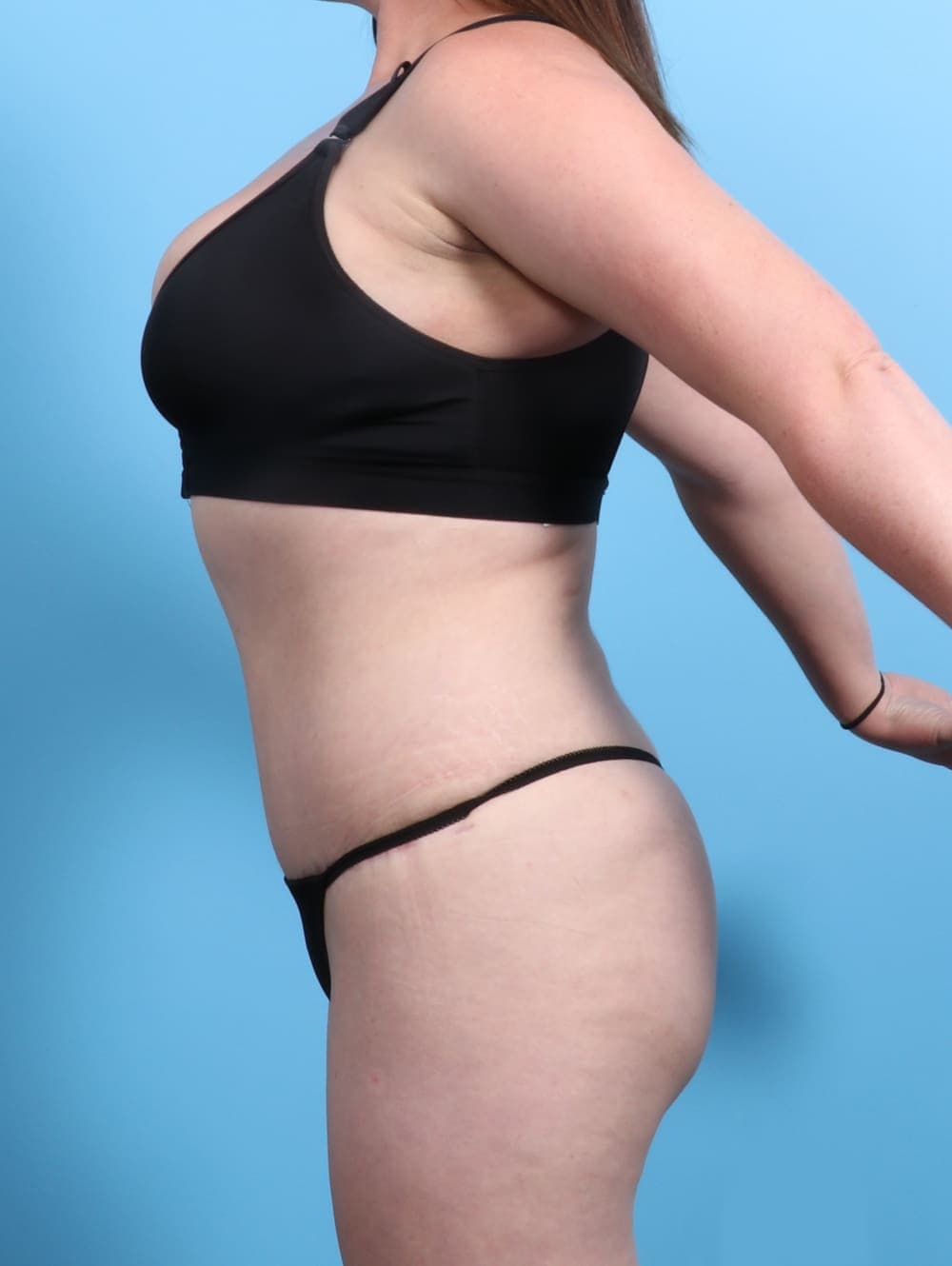 Tummy Tuck case #2370 after, image 3