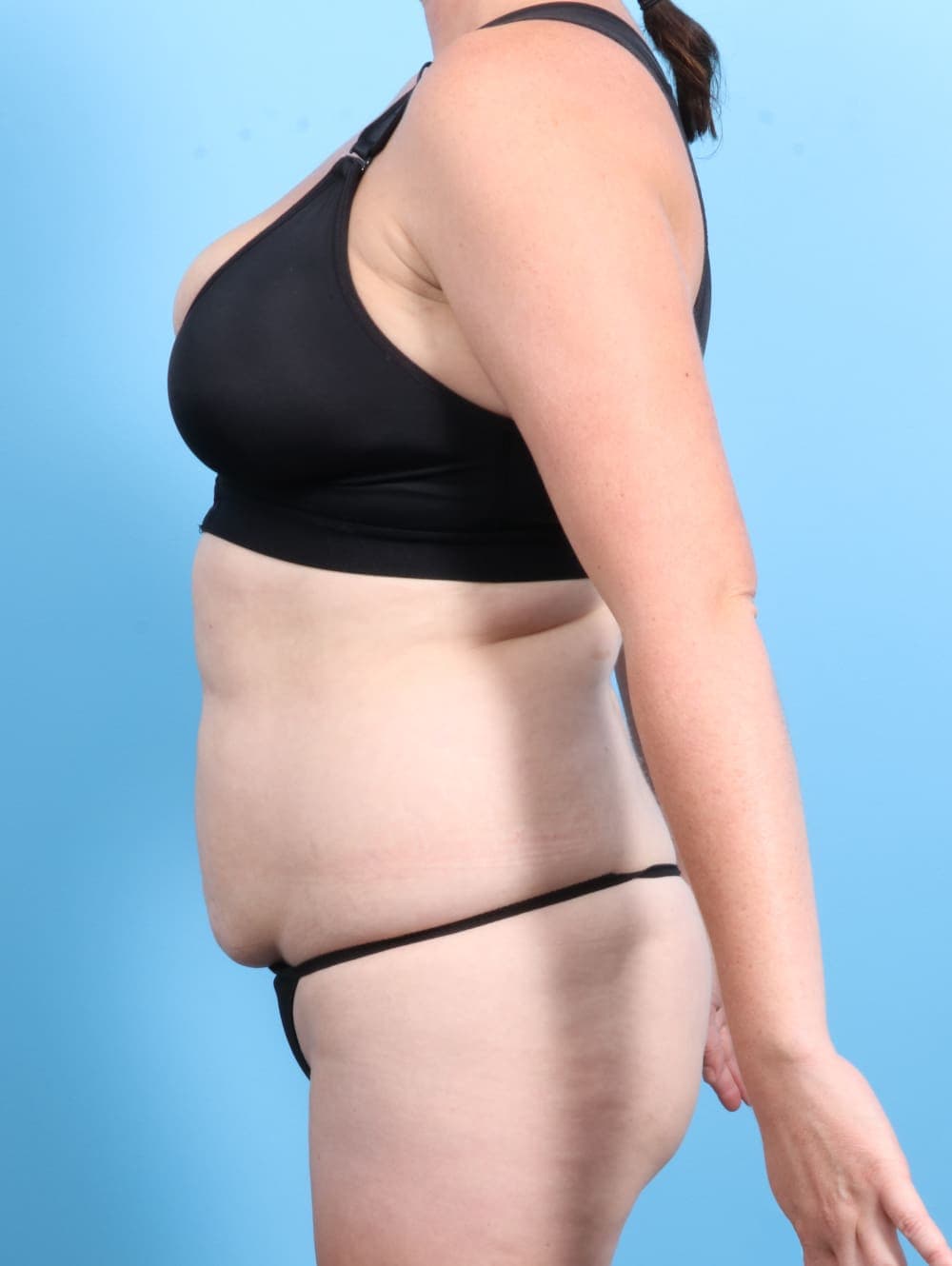 Tummy Tuck case #2370 before, image 3