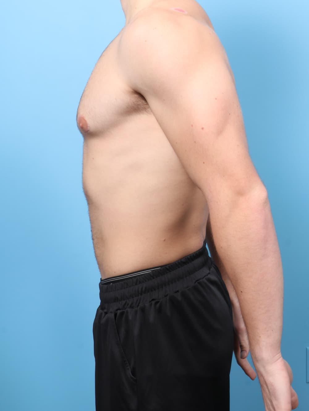 Male Breast Reduction case #8800 after, image 3