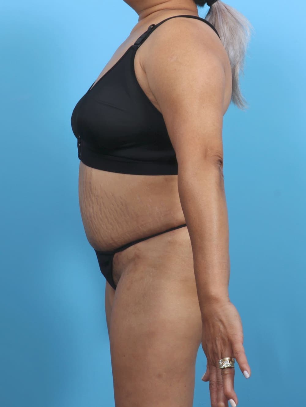 Liposuction case #5676 after, image 4