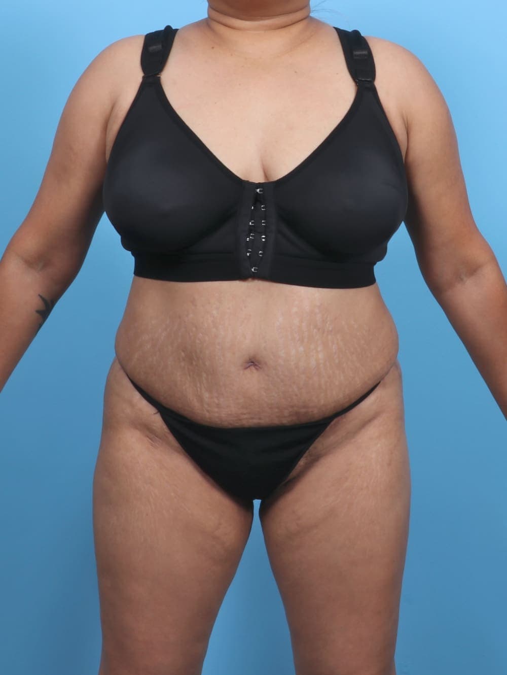 Liposuction case #5676 after