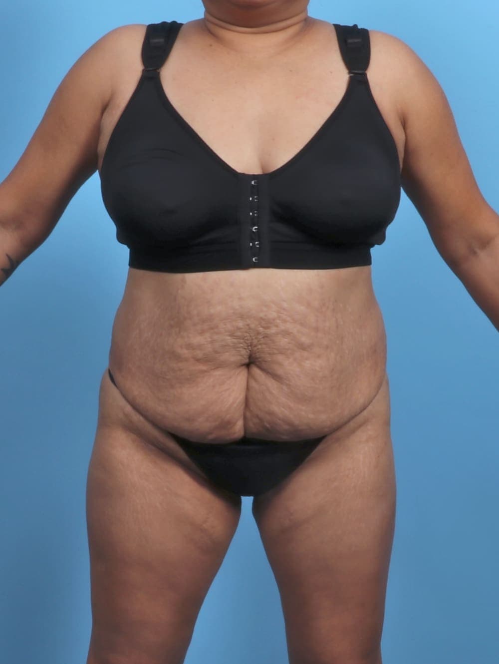 Liposuction case #5676 before
