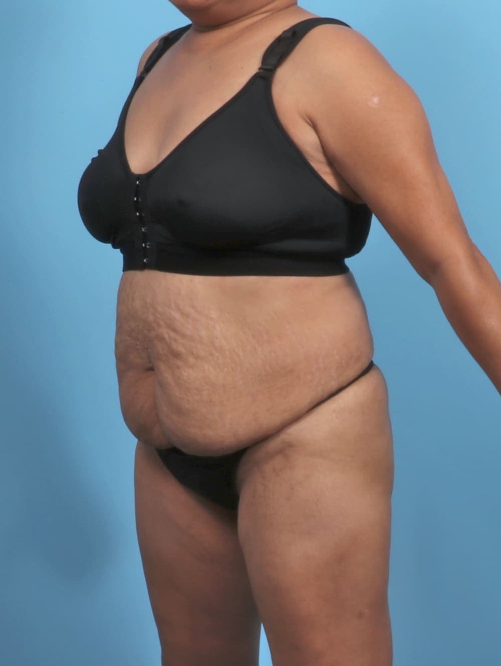 Liposuction case #5676 before, image 3