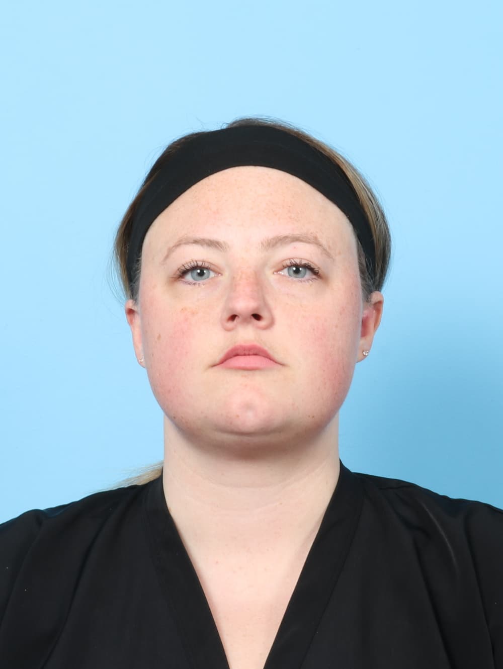 Facial Surgery case #7642 after