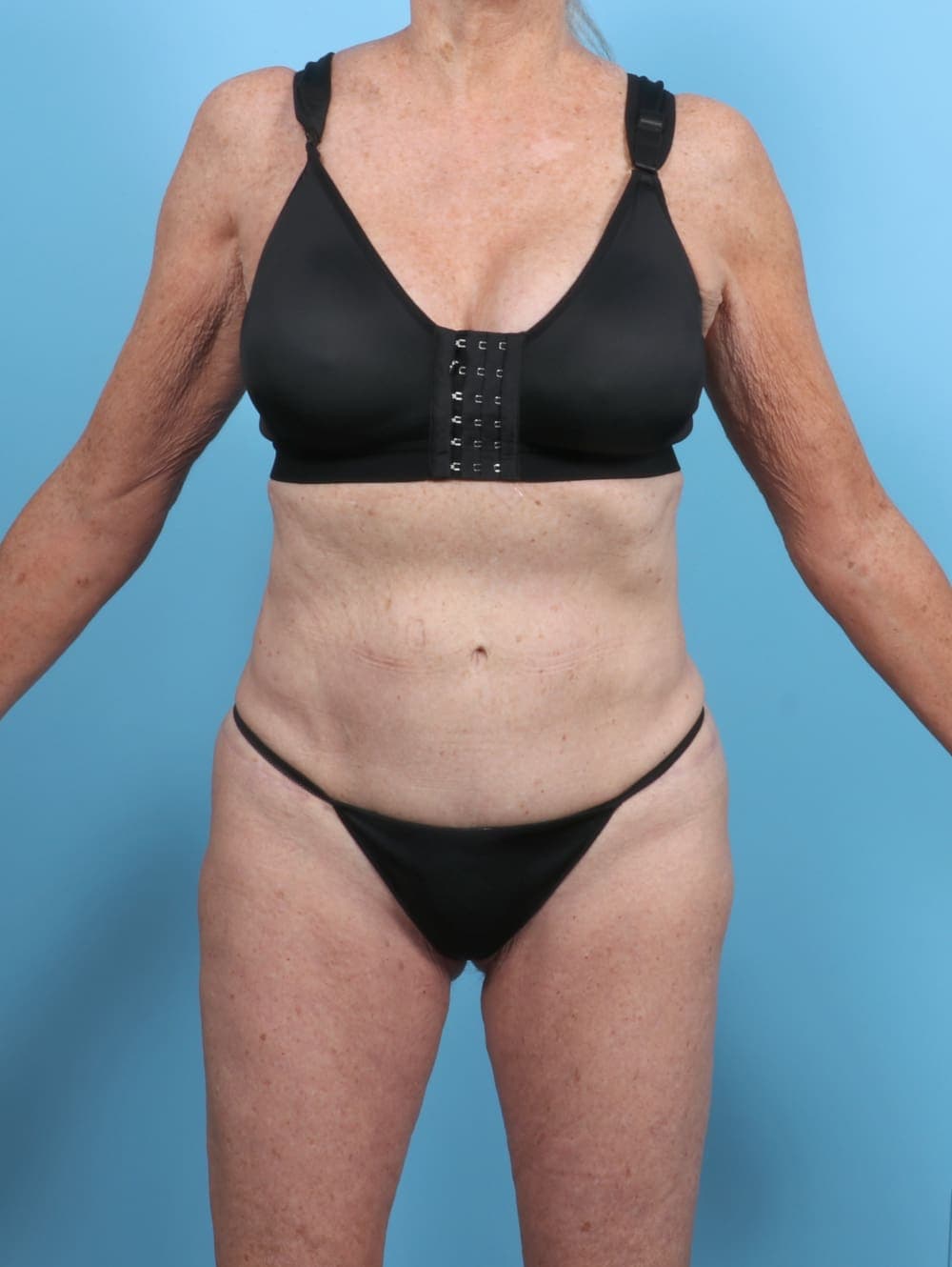 Tummy Tuck case #5576 after, image 1