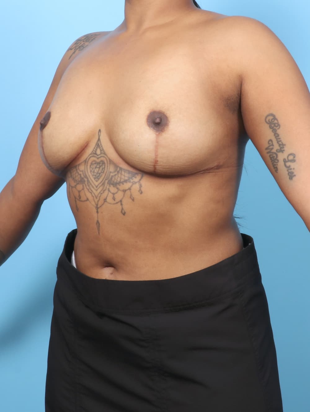 Breast Implant Revision case #8690 after, image 2