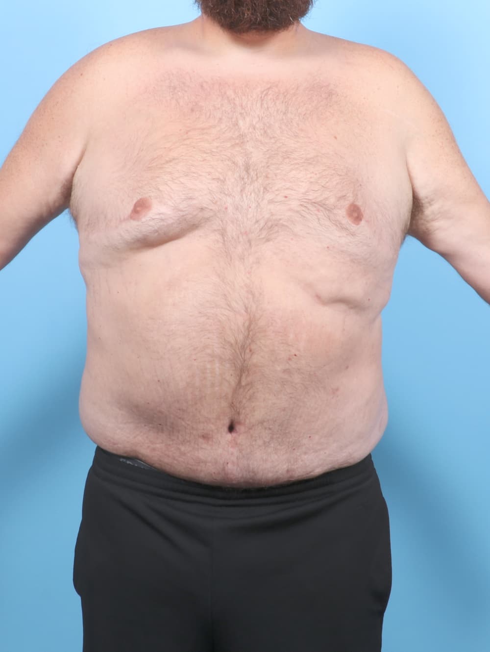 Tummy Tuck case #7122 after