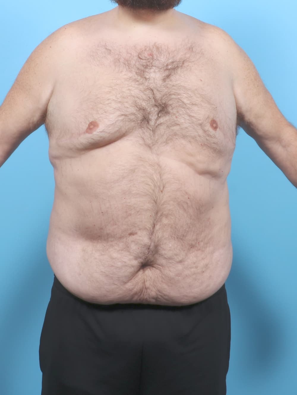Tummy Tuck case #7122 before