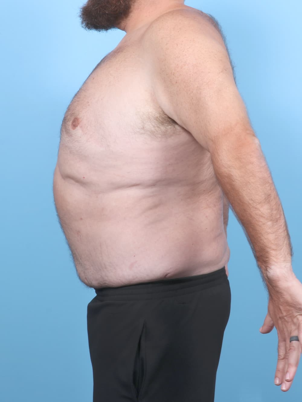 Tummy Tuck case #7122 after, image 3